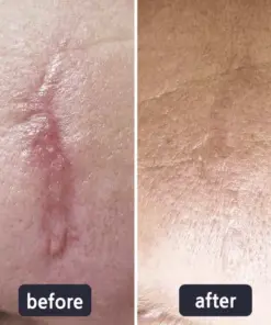 LBMLBM™ Medical-Grade Silicone Scar Gel