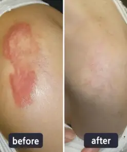 LBMLBM™ Medical-Grade Silicone Scar Gel