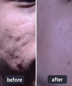 LBMLBM™ Medical-Grade Silicone Scar Gel